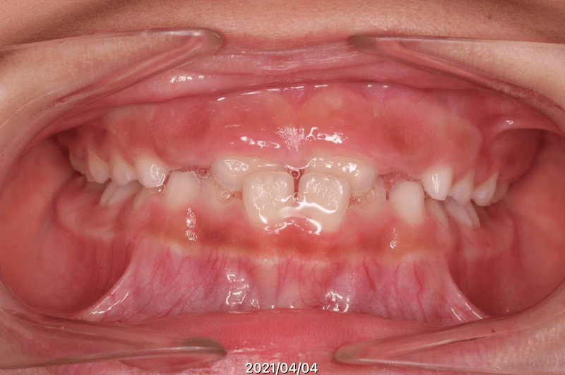 反対咬合（受け口・下顎前突）のBefore