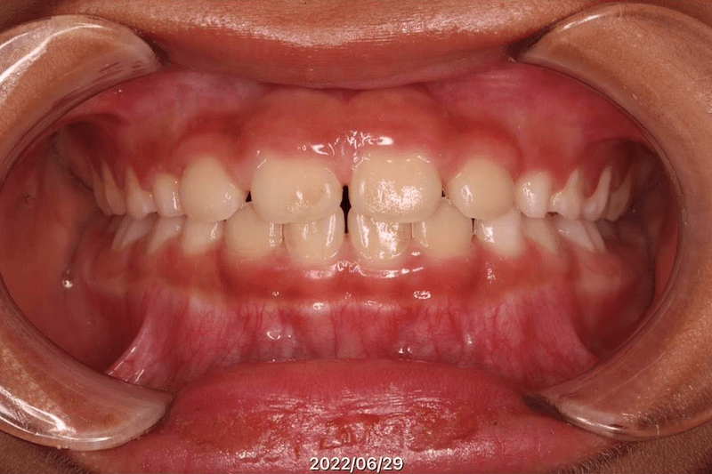 反対咬合（受け口・下顎前突）のAfter