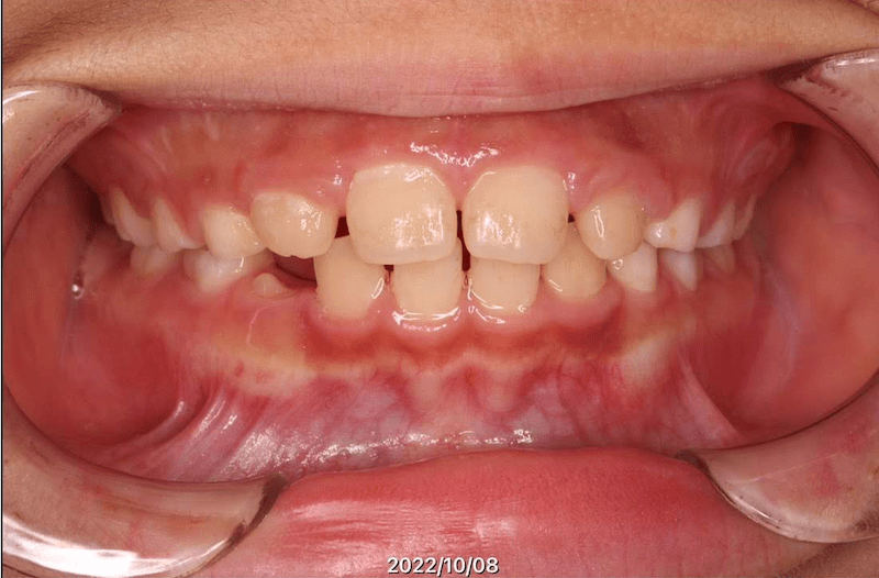 過蓋咬合のAfter