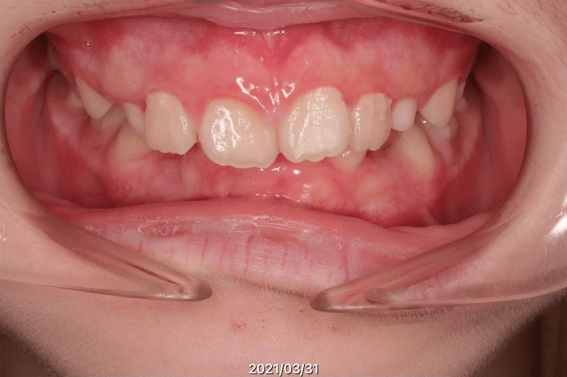 過蓋咬合のBefore