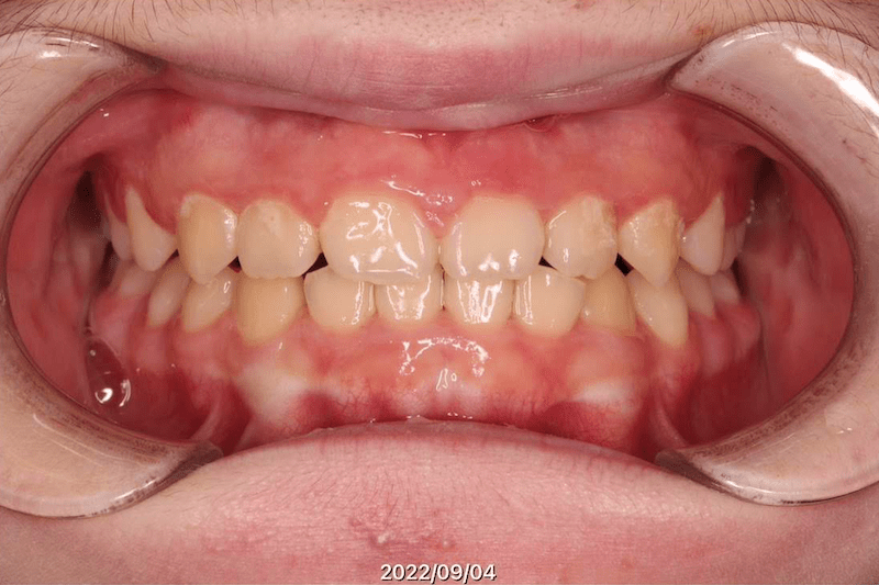 過蓋咬合のAfter