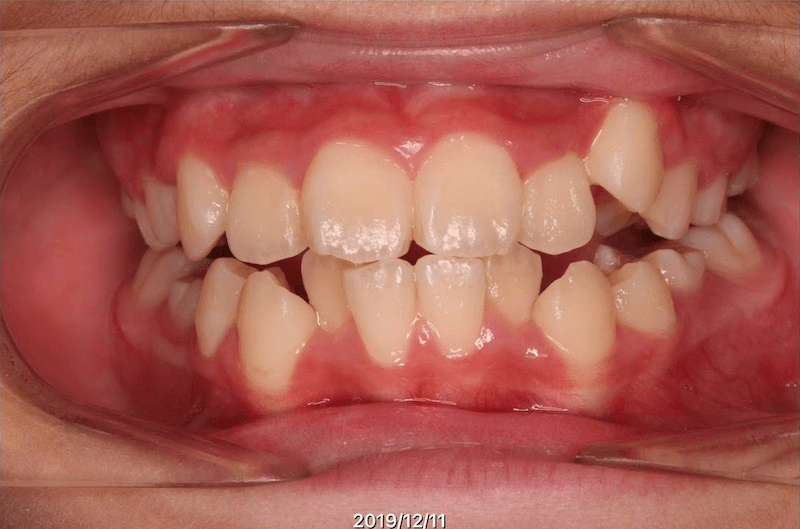 上下叢生（上左八重歯）のBefore