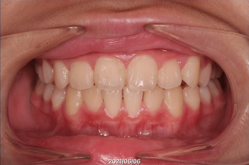 上下叢生（上左八重歯）のAfter