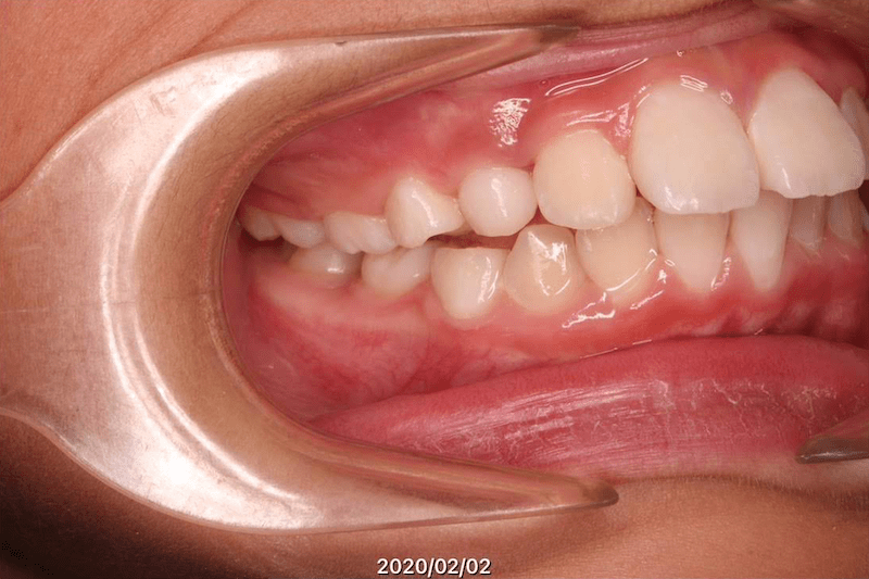 上顎前突（出っ歯）のBefore