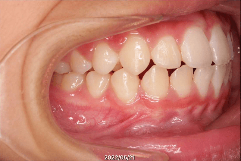 上顎前突（出っ歯）のAfter