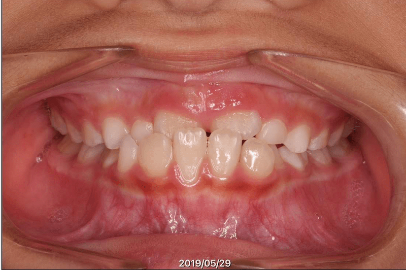 反対咬合（受け口・下顎前突）のBefore