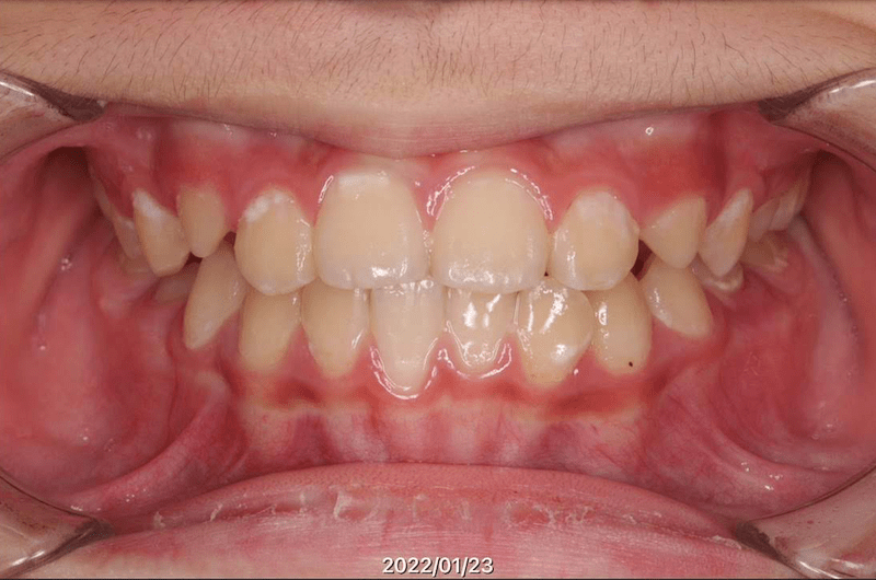 反対咬合（受け口・下顎前突）のAfter