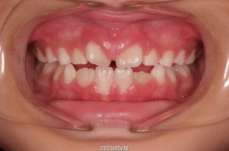 翼状捻転のBefore