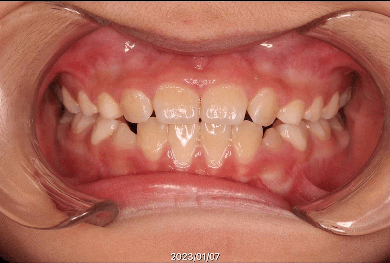 翼状捻転のAfter