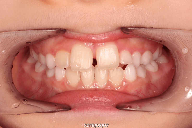 空隙（すきっ歯）のBefore