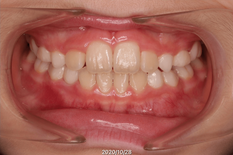 空隙（すきっ歯）のAfter